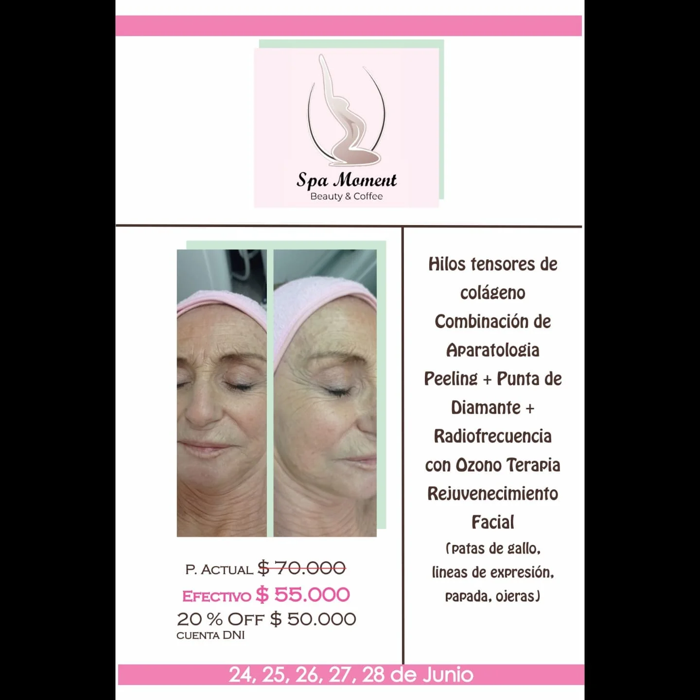 Dos fotos de una clienta con vincha rosa y los ojos cerrados, durante su tratamiento de hilos de colágeno con aparatología